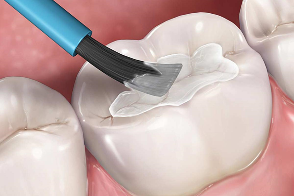 Trám răng thẩm mỹ bao nhiêu tiền và những điều bạn cần lưu ý